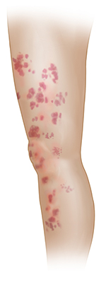 Side view of a leg with a patchy rash from thigh to calf.