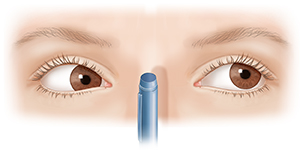 Front view of adult eyes focusing with convergence insufficiency.