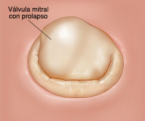 Vista superior de una válvula mitral cerrada con prolapso.