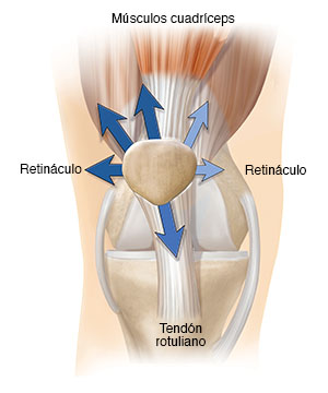 Vista delantera de una articulación de la rodilla normal con flechas que muestran fuerzas que jalan de manera irregular de la rótula.