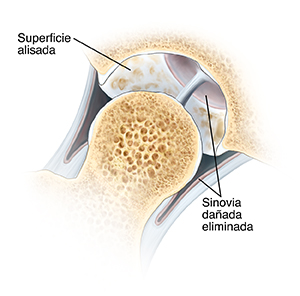 Corte transversal de una articulación de cadera en donde se ve la cabeza del fémur que se separó de la cavidad de la cadera. El cartílago que reviste la cavidad se alisa. Se quita el sinovio dañado.