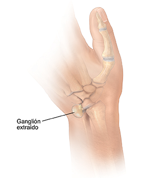 Vista posterior de la mano donde puede verse una línea punteada alrededor de un quiste ganglionar en la muñeca.