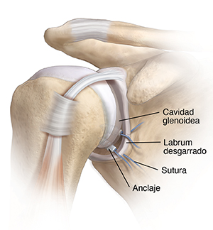 Articulación del hombro que muestra la cavidad glenoidea, el labrum desgarrado y una sutura de anclaje