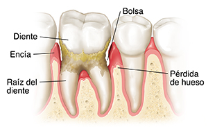 Dientes en encías que muestran periodontitis avanzada.