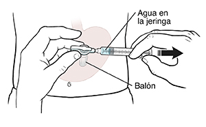 Vista frontal de un abdomen donde se ve una sonda de gastrostomía, un globo y una jeringa. Manos sosteniendo la jeringa en la sonda de gastrostomía mientras se extrae agua del globo.