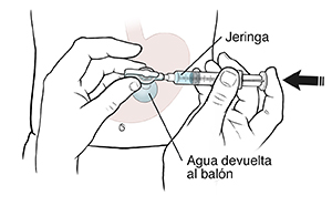 Vista frontal de un abdomen donde se ve una sonda de gastrostomía, un globo y una jeringa. Manos sosteniendo la jeringa en la sonda de gastrostomía mientras se presiona el émbolo para llenar el globo con agua.