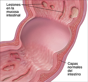 Corte transversal del colon con enfermedad de Crohn.